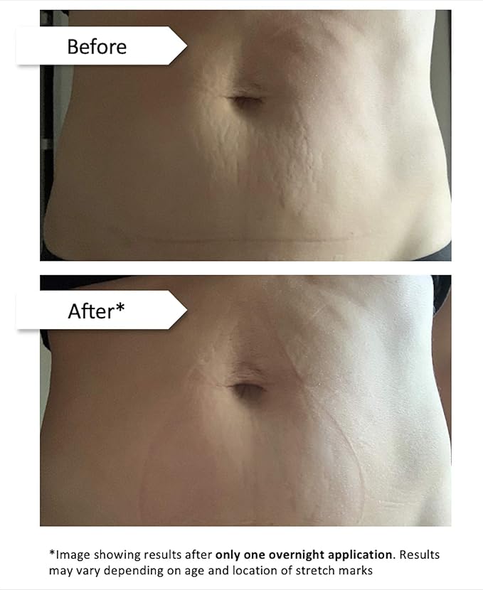 Stretch Mark Eraser | Overnight Stretch Mark Treatment | 1 patch