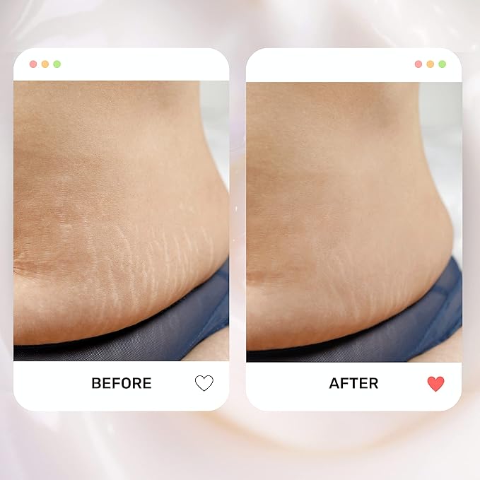 S1 Stretch Mark Cream, 150ml / 5oz, Lightweight Pregnancy Stretch Mark Cream