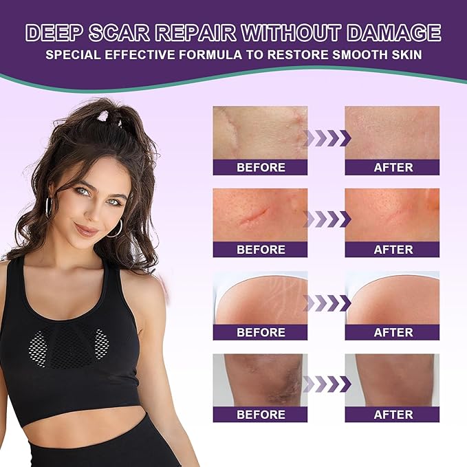 Silicone Scar Cream Scar Gel - Advanced Scar Gel Scar Treatment for Stretch Marks Removal, Old & New Scars, Surgical Scars, Burns, Acne, C-Section, Keloid Scar Treatment for Women & Men, 1.76Oz