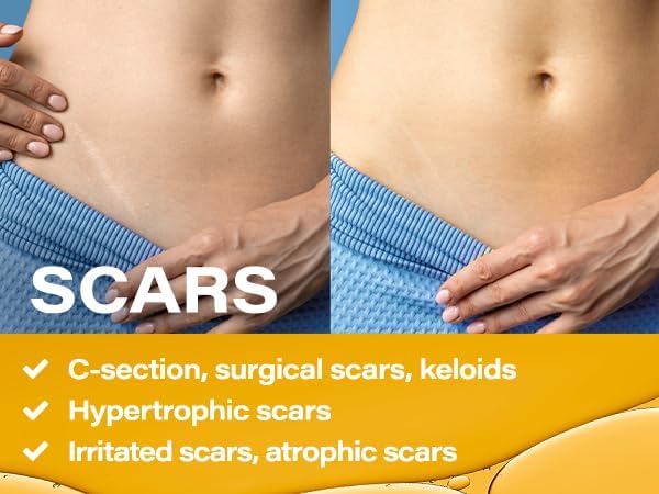 Lymphatic Drainage Massage Oil with Arnica, Collagen and Stem Cells, Post Surgery Recovery &, Liposuction, 360 Lipo, BBL, Tummy Tuck, Fibrosis Treatment, 8.5 Oz