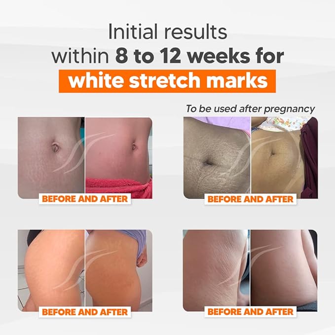 Cicatrissim Anti Stretch Mark Cream for Pregnancy - Brazilian Flora - Postpartum Stretch Marks Removal Cream for Belly, Thigh, Butt, Legs- Maternity Stretchmark Prevention & Remover for all Skin Types