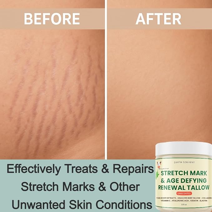 Stretch Mark & Age Defying Renewal Tallow – Yam Root, Coll-agen, Biotin, Vitamin C, Dead Sea Minerals, Hyaluronic Acid, Keratin & Elastin (8 fl oz, Warm Scent)