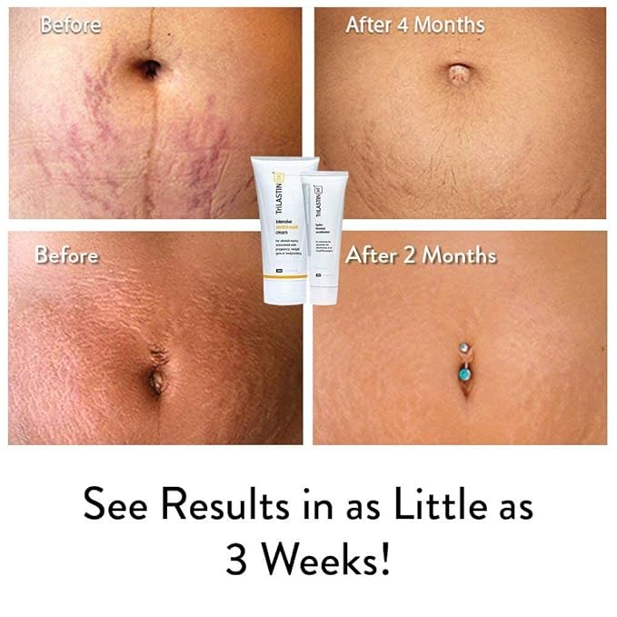 TriLASTIN Stretch Mark Cream for Pregnancy - 5.5 Oz & 3 Oz Hydro-Thermal Accelerator & Absorption Serum - Intensive Moisturizing Formula with Hyaluronic Acid - Prevent Stretch Marks During Pregnancy