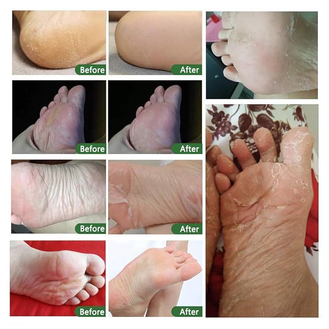 Foot Peel Mask - 5Pack, Exfoliating Foot Care Mask Make Soft Baby Feet Peel, Foot Exfoliator Repair Dead Skin, Calluses, Chapped, Rough Feet (Tea Tree)