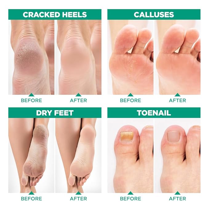 Tea Tree Foot Soak (1 lb) and Foot Peel Mask - Foot Care Kit For Dry Cracked Feet and Heels - Remove Dead Skin and Calluses - Treats Athlete's Foot and Stubborn Foot Odor