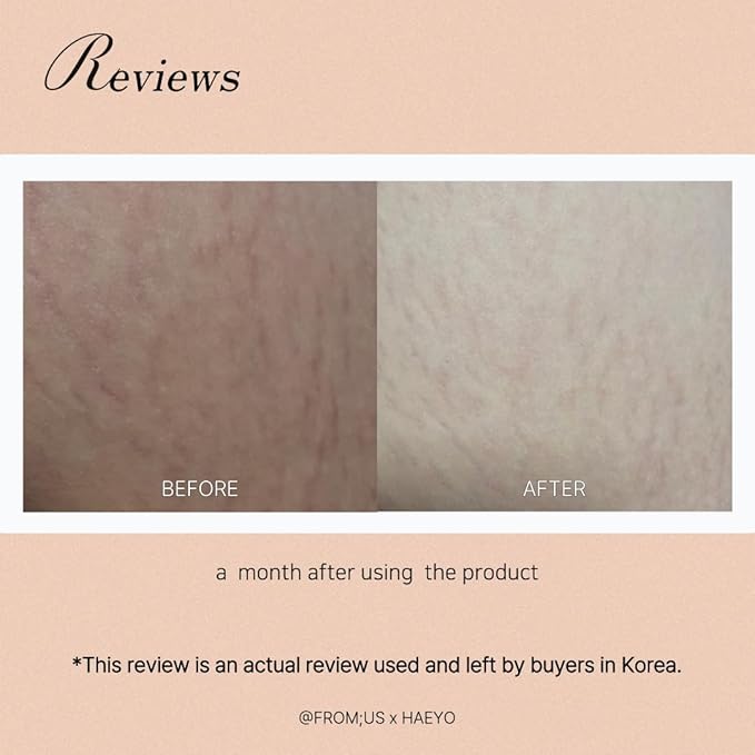 [Antley] Stretch Care Cream | Antley Ointment Gel-type | Medical Device Effective for Pregnant Dieters Adolescents (Gel Type), White