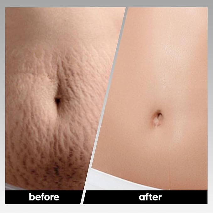 Stretch Mark System for Skin Care - Stretch Marks Removal, At-Home Beauty Tool for Postpartum Skincare | Improve the Look of Uneven Skin Texture, Firmness & Smooth, Glowing-Looking Skin