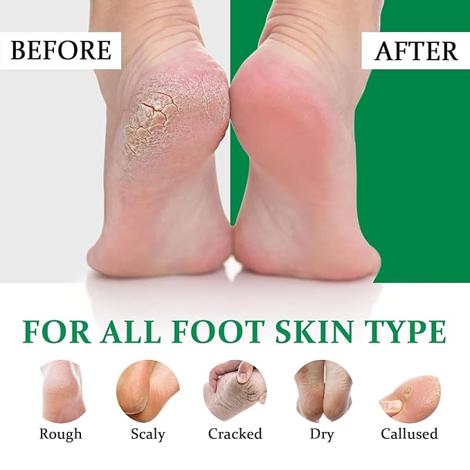 Tea Tree Oil Foot Cream for Dry Cracked Feet,Hydrating Foot Cream For Women Men (8oz)