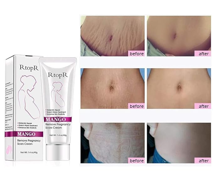 RtopR Mango Stretch Marks and Scar Cream -Stretch Marks and Scar Removal Cream for Pregnancy - Best Body Moisturizer-40g