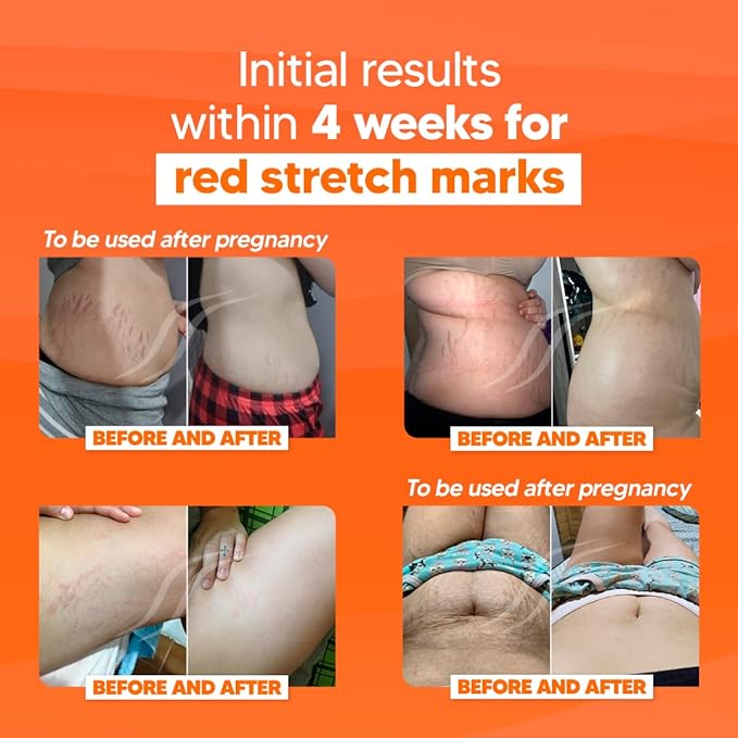 Cicatrissim Anti Stretch Mark Cream for Pregnancy - Brazilian Flora - Postpartum Stretch Marks Removal Cream for Belly, Thigh, Butt, Legs- Maternity Stretchmark Prevention & Remover for all Skin Types