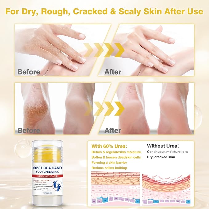 60% Urea Cream with 2% Salicylic Acid Foot Balm, Portable Hand Cream, Foot Cream for Dry Cracked Heels and Feet Hand, Urea Heel Care Stick Callus Remover & Skin Softener, 1oz