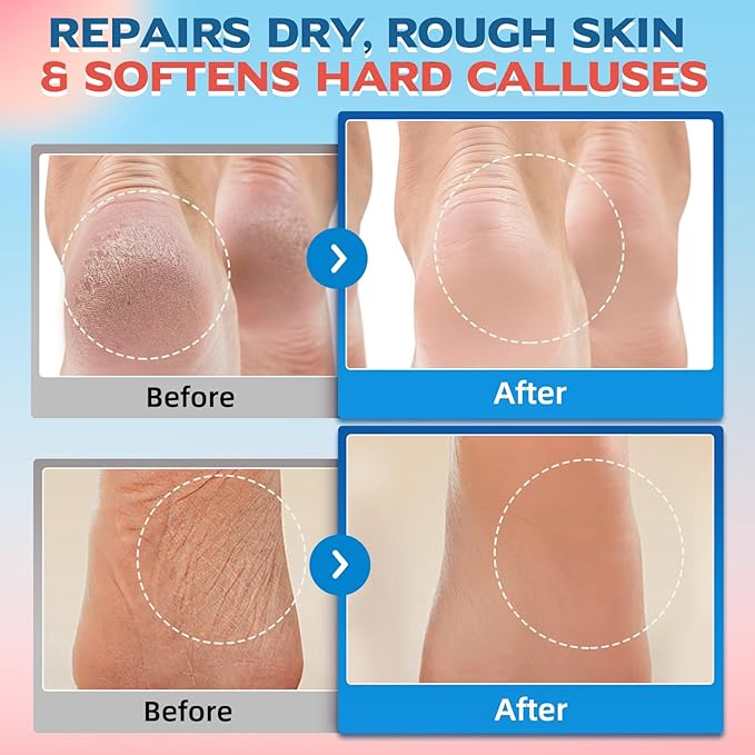 Crack Feet Prevention Stick & Moisturizing Foot Balm – Anti Crack Foot Cream for Dry Cracked Heels and Feet, Removes Dead Skin, Softens Hard Skin (Pink+Blue)