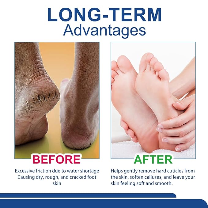 Soelegant Urea Cream, Urea Foot and Hand Cream for Dry, Cracked, Callus and Dead Skin, Moisture Stick for Foot Care, Cracked Heel Treatment, Knees, Elbows, Hands, Repair,