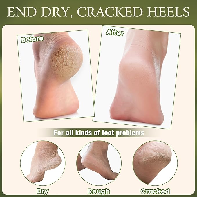 4 Pcs Cracked Heel Treatment & Repair Stick Set (with 2 Foot Balms + 2 Heel Socks) – Rose Oil & Jojoba Oil Infused cracked heel stick Balm for Dry, Cracked Heels – No-Mess Applicator, Travel-Friendly