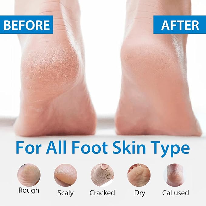 Urea Cream 40 Percent for Feet,40% Urea 2% Salicylic Acid Foot Cream,Foot Cream and Hand Cream with Cocos Nucifera Oil,Tea Tree,Aloe Vera,Vitamin E (5.29 OZ/150g)