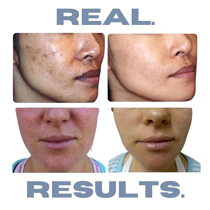 Acne Treatment Kit, Acne Kit, Skin Care Acne, Acne Skin Care Set, Natural Anti-DHT Deluxe Set Sensitive Skin 3-Piece Set, 2-Month Supply