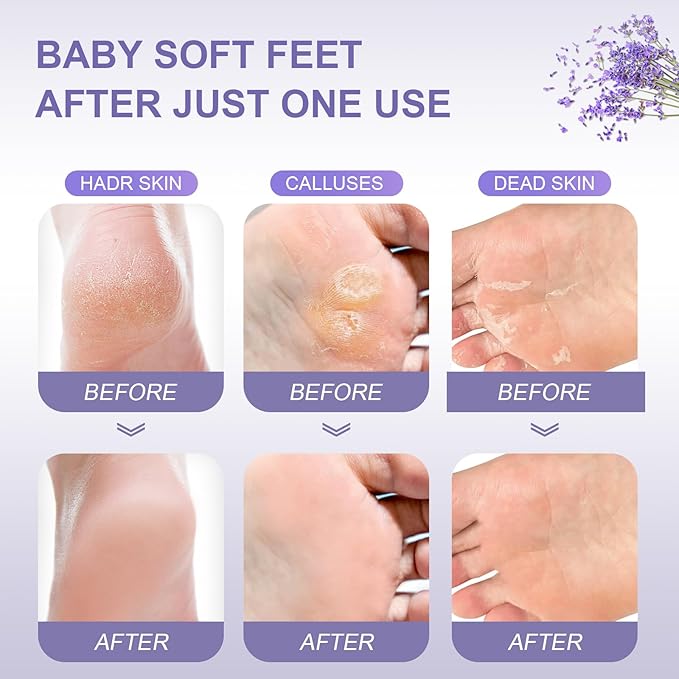 Foot Peel Mask Exfoliant for Peeling Off Calluses, Natural Exfoliator for Callus, Dry Dead Skin, Repair Rough Heels
