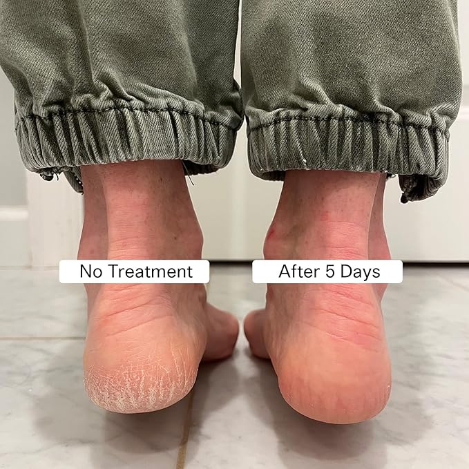 Cracked Heel Repair Foot Care Balm, Smooths & Fills Cracks & Rough Skin with Healing Shea & Mango Butters, Vegan, Cruelty Free, 1 oz