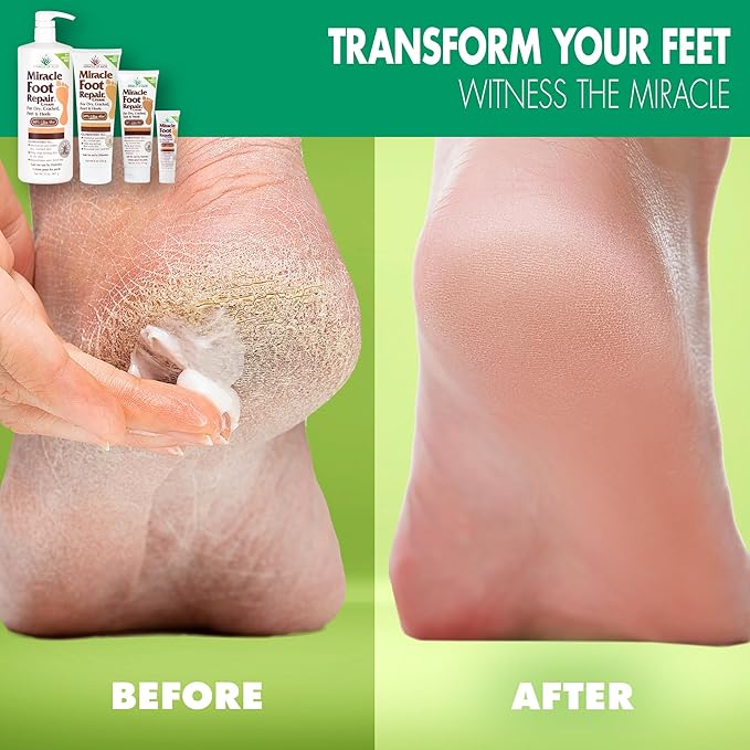 Miracle Foot Repair Cream (1 oz / 12 Pack) Repairs Dry Cracked Heels and Feet, 60% Pure Ultra Aloe Moisturizes, Softens, and Repairs