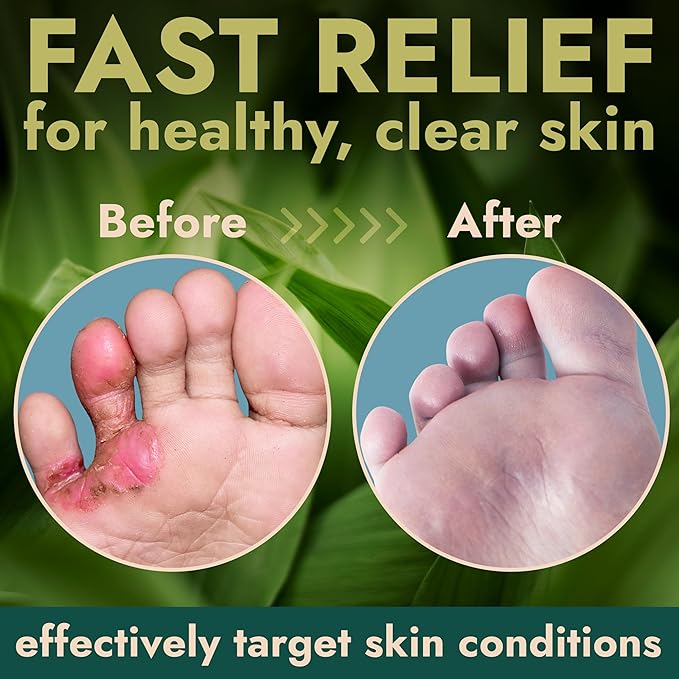 Tea Tree Oil Antifungal Foot Gel | Relieves Jock Itch, Athlete’s Foot & Ringworm | Soothes Itching & Burning | Moisturizes Dry, Cracked Feet | No-Touch Applicator | 1-Week Treatment Option | 20g